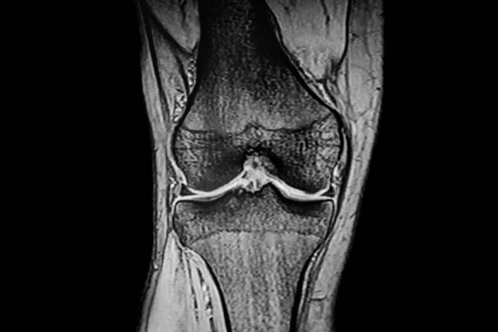 Cryoanalgesia in Orthopedic Surgery