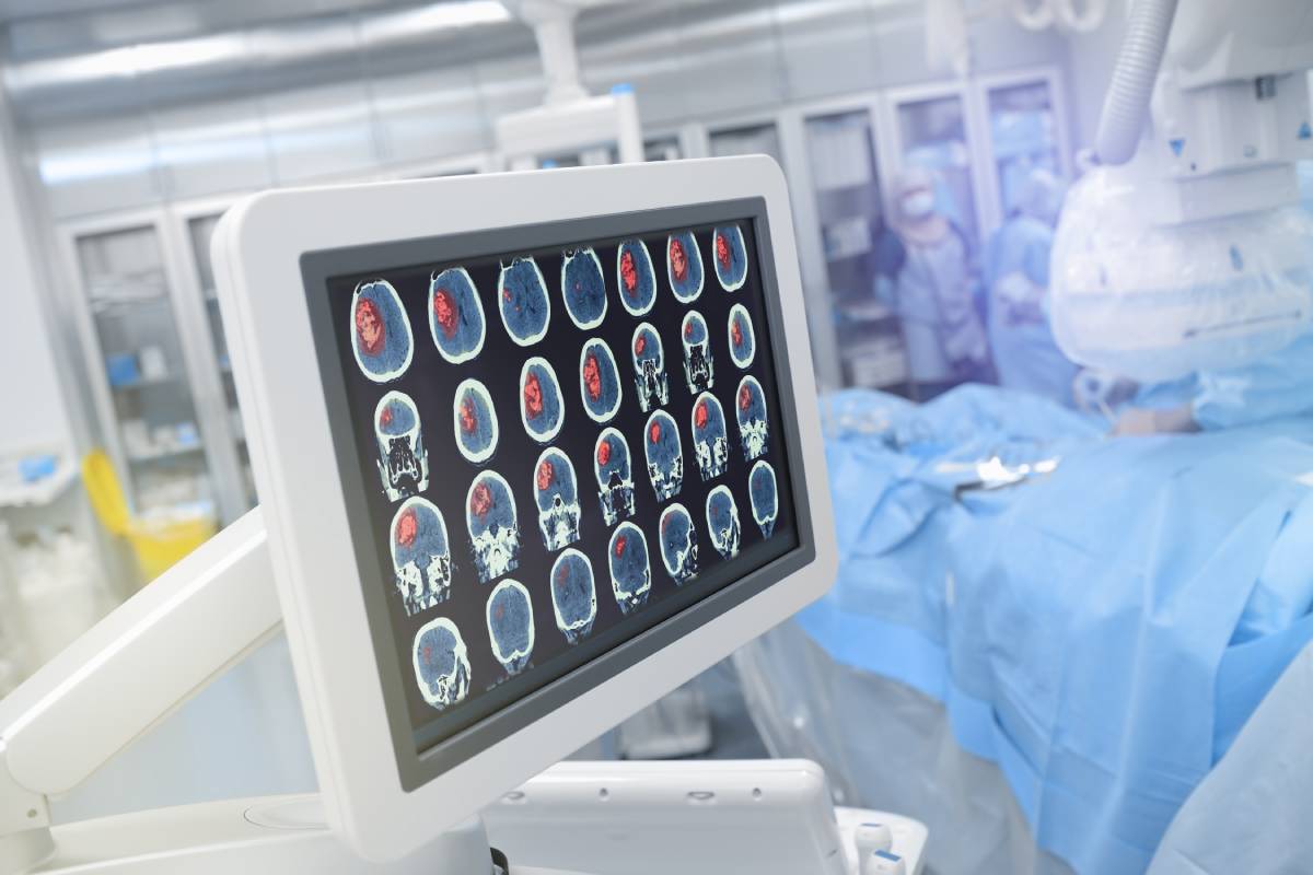Intraoperative Seizures