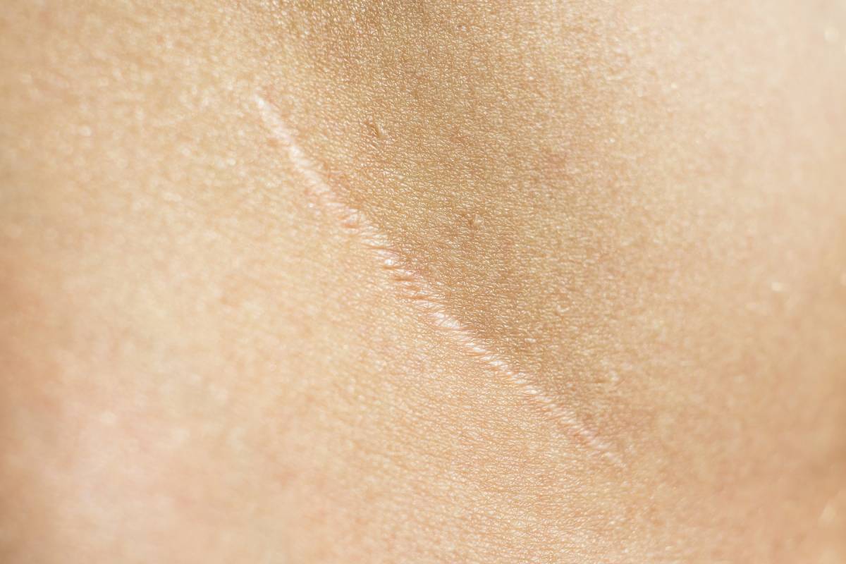 Mechanism of Wound Scarring