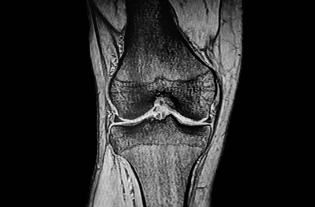 Cryoanalgesia in Orthopedic Surgery