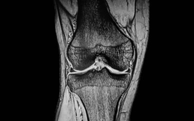 Cryoanalgesia in Orthopedic Surgery