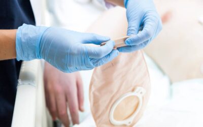 Anesthesia for Ostomy Surgery